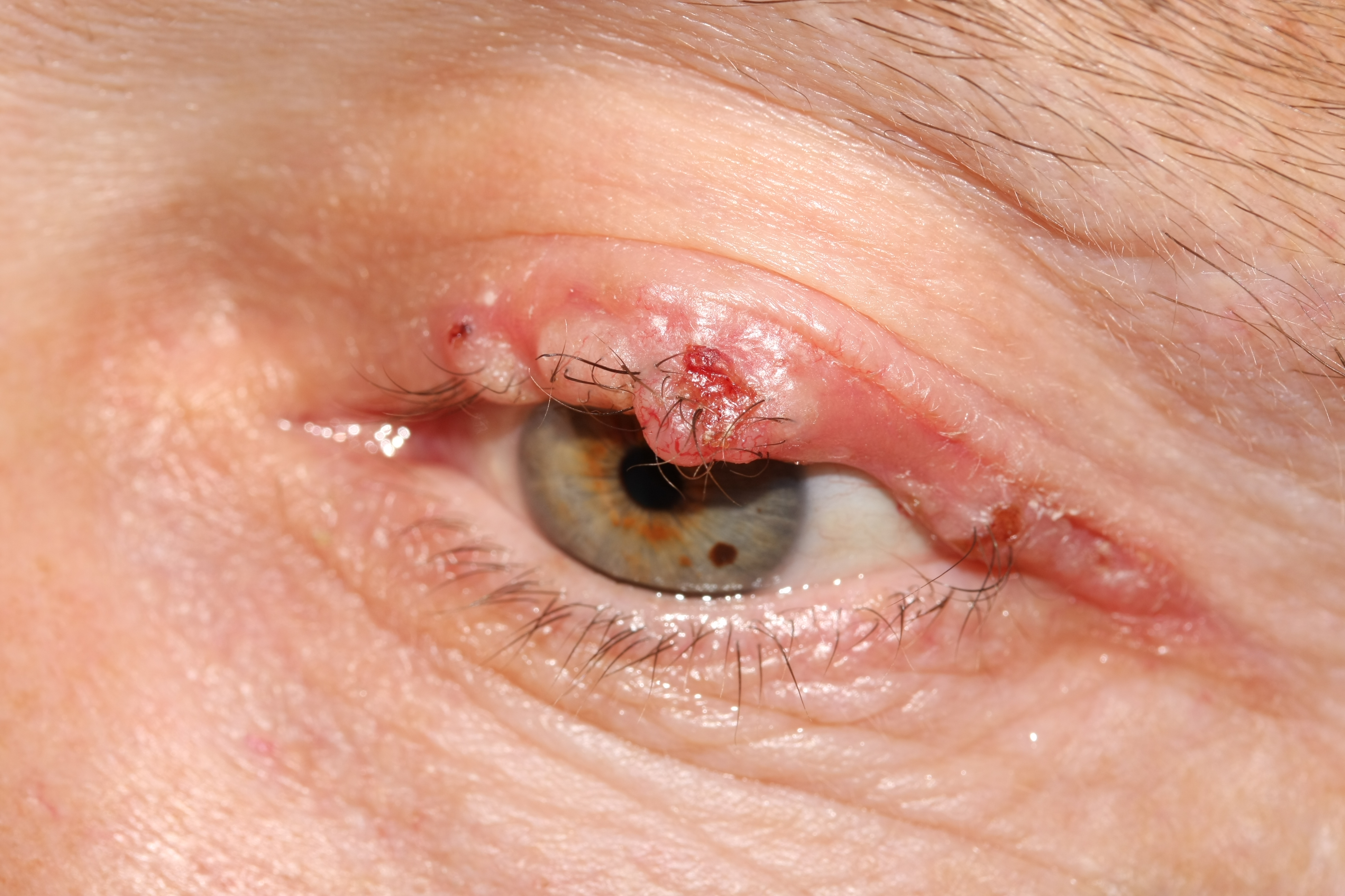 Liverpool Eye Clinic Eyelid Cysts